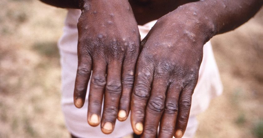 ‘Urgency’: WHO expects more monkeypox cases globally – Al Jazeera English