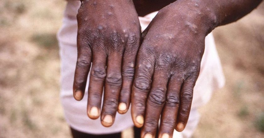 1 confirmed, 6 presumptive monkeypox cases in US, government releasing vaccines for exposed – ABC News