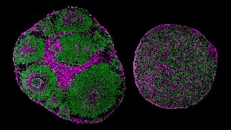 Gene Therapy Reverses Effects of Autism-Linked Mutation in Human Brain Organoids – SciTechDaily