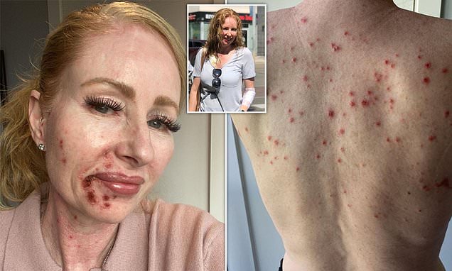 Skin cancer-stricken mother reveals chemo cream leaves her looking like an acid attack victim – Daily Mail