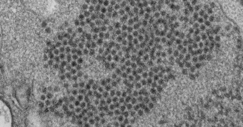 Puzzling pediatric hepatitis cases echo an earlier mysterious illness – STAT